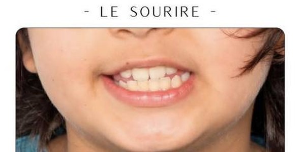 Après traitement orthodontique enfant — Dr Amine Ben Ayed, Tunis
