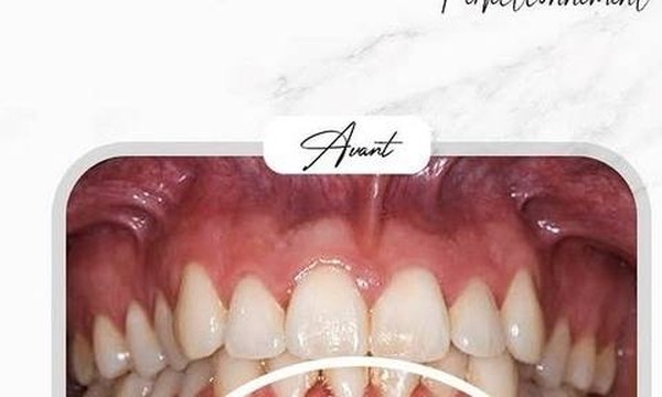 Après perfectionnement Ideal Smile Arc — Dr Amine Ben Ayed, Tunis